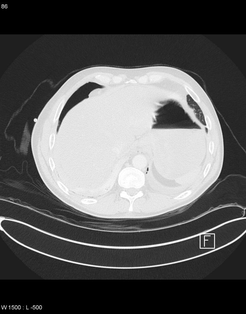 Boerhaave syndrome with tension pneumothorax (Radiopaedia 56794-63605 Axial lung window 42).jpg