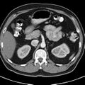 Bosniak cyst - type IV (Radiopaedia 23525-23627 renal cortical phase 14).jpg