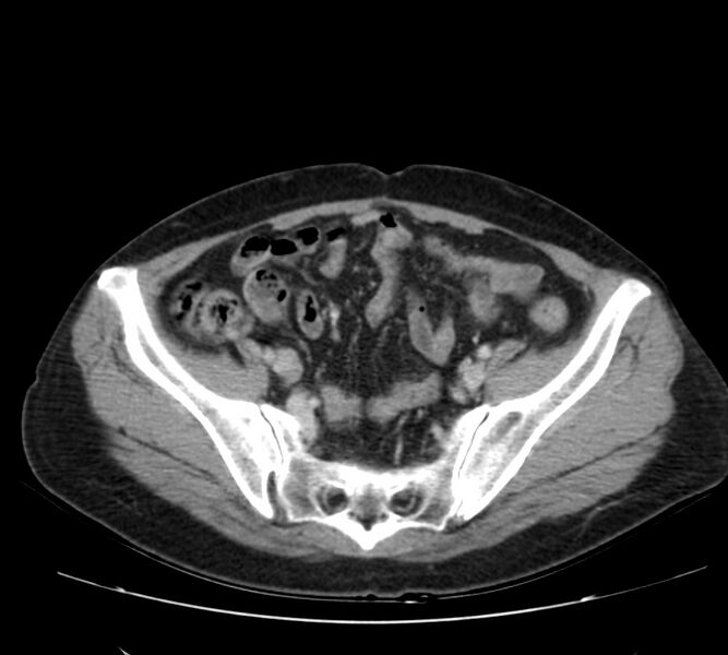 File:Bosniak renal cyst - type IV (Radiopaedia 22929-22953 C 52).jpg