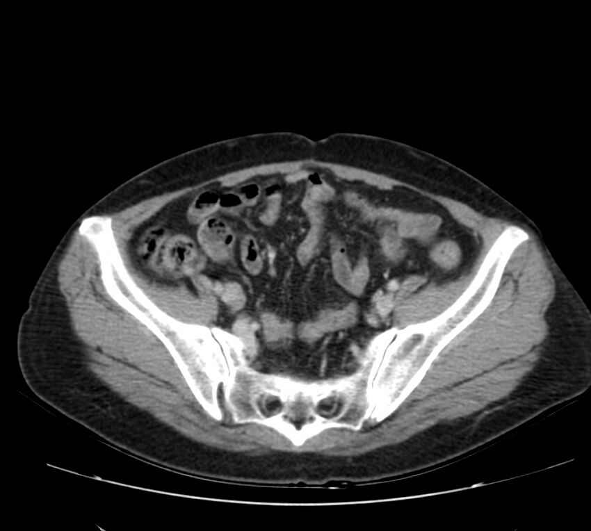 Bosniak renal cyst - type IV (Radiopaedia 22929-22953 C 52).jpg