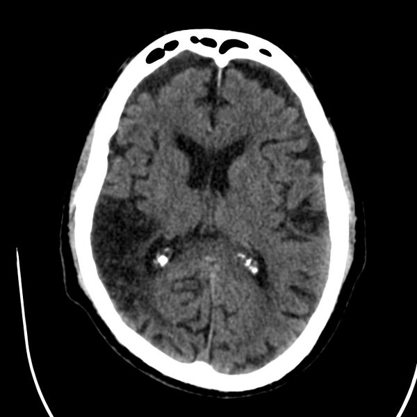 File:Brain Pantopaque remnants (Radiopaedia 78403-91048 Axial non-contrast 54).jpg