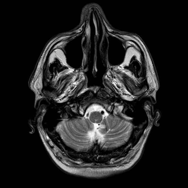 File:Brain abscess complicated by intraventricular rupture and ventriculitis (Radiopaedia 82434-96577 Axial T2 2).jpg