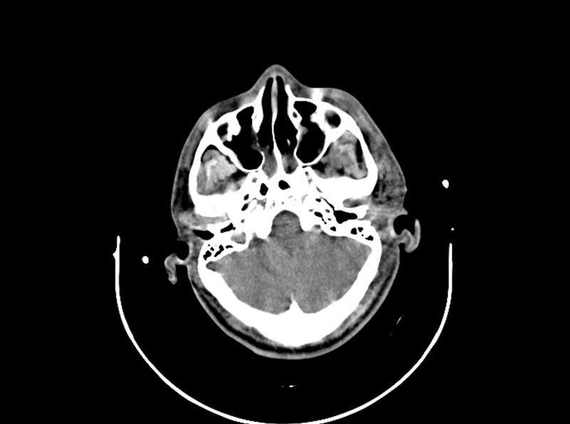 File:Brain injury by firearm projectile (Radiopaedia 82068-96087 B 59).jpg