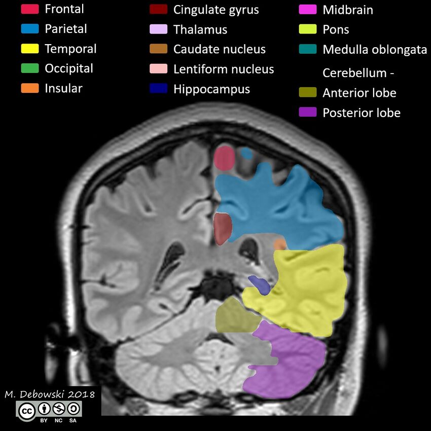 Brain lobes - annotated MRI (Radiopaedia 61691-69700 Coronal 48).JPG