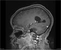 Brainstem glioma (Radiopaedia 21819-21775 D 14).jpg