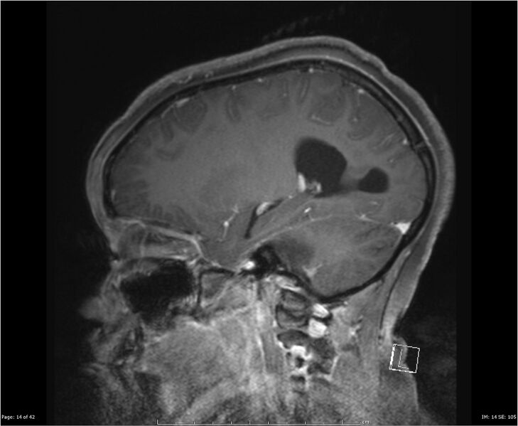 File:Brainstem glioma (Radiopaedia 21819-21775 D 14).jpg