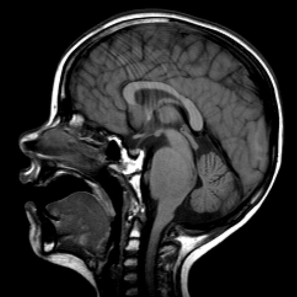 File:Brainstem glioma (Radiopaedia 5683-7390 Sagittal T1 1).jpg