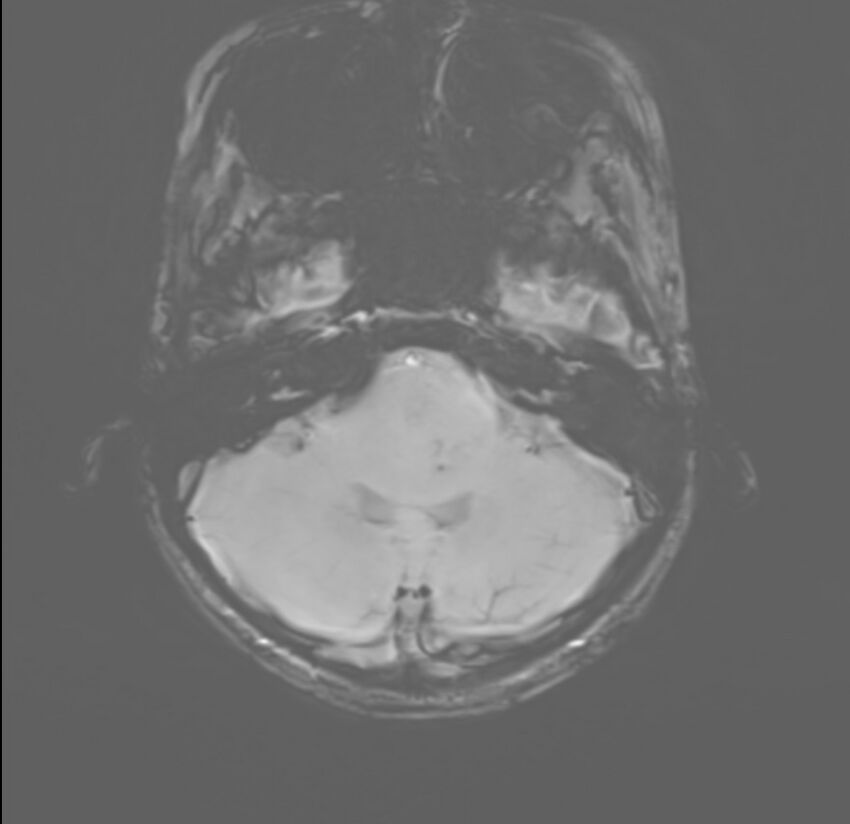 Brainstem glioma (Radiopaedia 70548-80674 Axial SWI 10).jpg