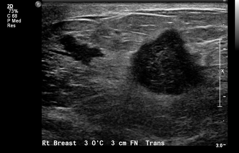 File:Breast cancer and multiple circumscribed masses (Radiopaedia 62456-70700 A 1).jpeg