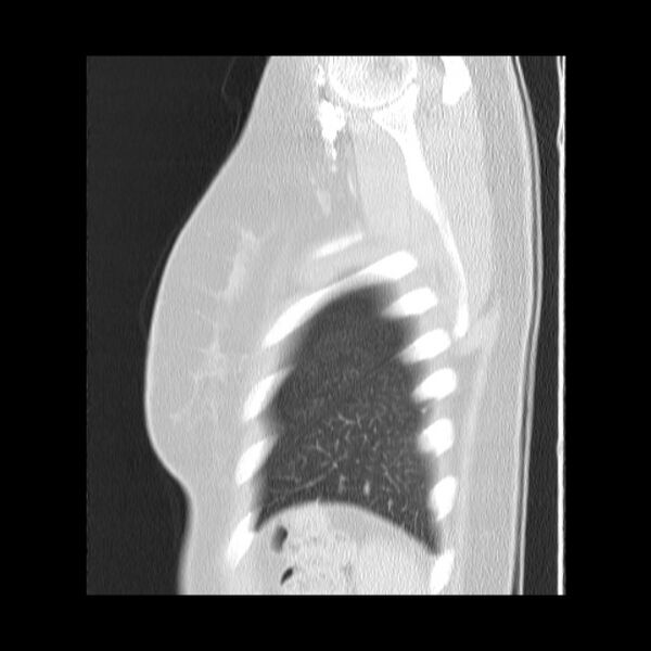 File:Bronchial atresia (Radiopaedia 22965-22992 Sagittal lung window 6).jpg