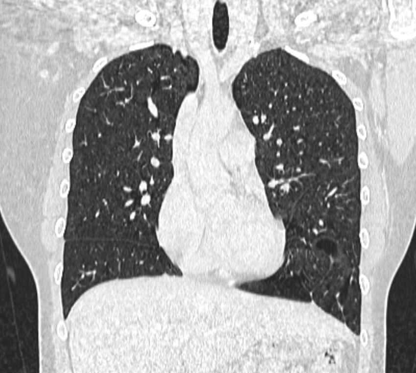 Bronchial atresia (Radiopaedia 50007-55297 Coronal lung window 39).jpg