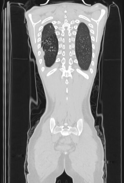 File:Bronchial carcinoid tumor (Radiopaedia 57187-64090 Coronal lung window 98).jpg
