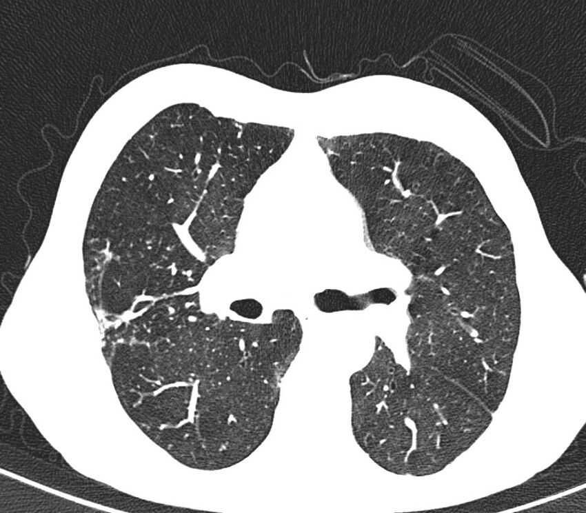 Bronchiolitis (Radiopaedia 24616-24887 Axial lung window 24).jpg