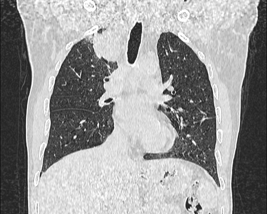 Bronchogenic carcinoma with superior vena cava syndrome (Radiopaedia 36497-38054 Coronal lung window 32).jpg