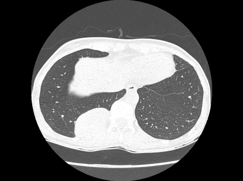 File:Bronchogenic cyst (Radiopaedia 80273-93615 Axial lung window 22).jpg