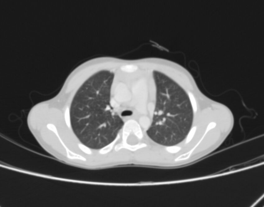 Bronchus suis (Radiopaedia 68131-77620 Axial lung window 22).jpg