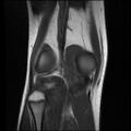 Bucket handle tear - lateral meniscus (Radiopaedia 72124-82634 Coronal T1 14).jpg
