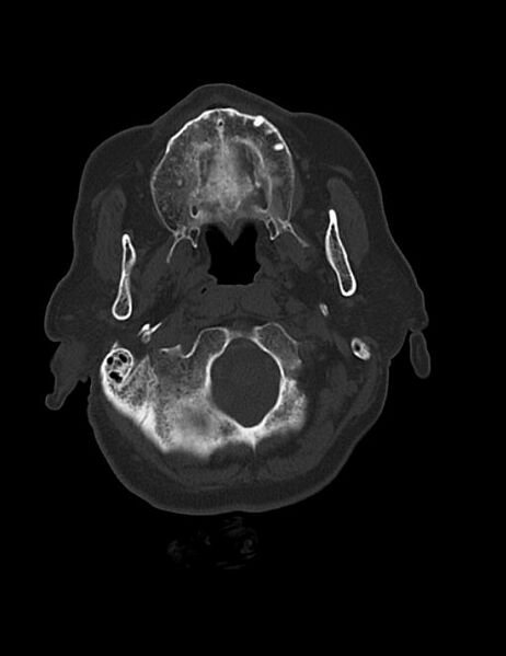 File:Burnt-out meningioma (Radiopaedia 51557-57337 Axial bone window 3).jpg