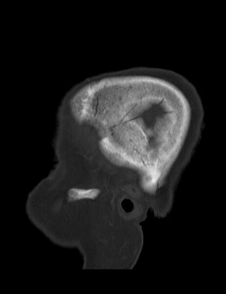 File:Burnt-out meningioma (Radiopaedia 51557-57337 Sagittal bone window 42).jpg