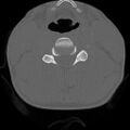 C5 facet fracture (Radiopaedia 58374-65499 Axial bone window 49).jpg