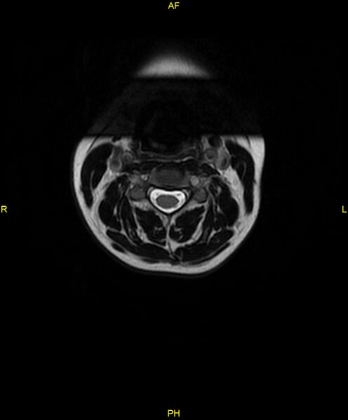 File:C5 nerve sheath tumor (Radiopaedia 85777-101596 Axial T2 13).jpg