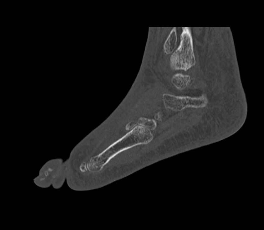 Calcaneal tuberosity avulsion fracture (Radiopaedia 22649-22668 Sagittal bone window 11).jpg