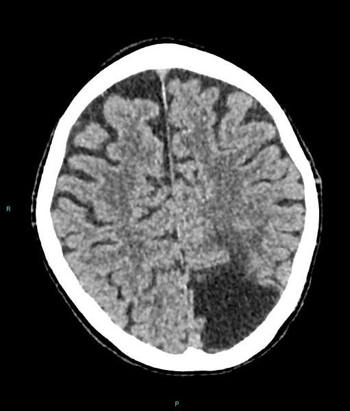 File:Calcified cerebral emboli from left ventricular thrombus (Radiopaedia 84420-99758 Axial non-contrast 30).jpg