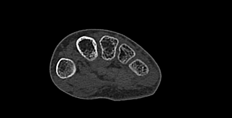 File:Calcifying aponeurotic fibroma (Radiopaedia 88423-105064 Axial bone window 130).jpg