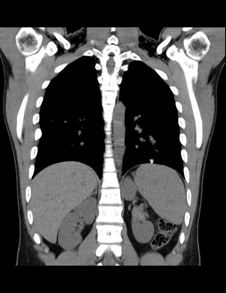 File:Calcifying pulmonary metastases (Radiopaedia 33359-34396 Coronal non-contrast 17).jpg
