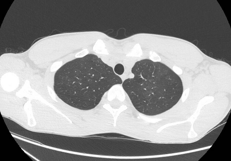 File:Cannabis-induced diffuse alveolar hemorrhage (Radiopaedia 89834-106946 Axial lung window 17).jpg