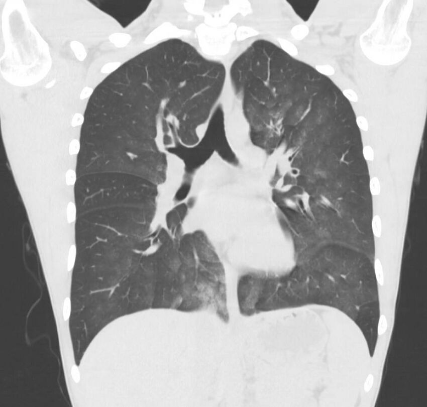 Cannabis-induced diffuse alveolar hemorrhage (Radiopaedia 89834-106946 Coronal lung window 44).jpg