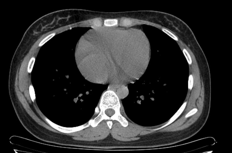 File:Cannonball metastases - uterine choriocarcinoma (Radiopaedia 70137-80173 Axial non-contrast 80).jpg
