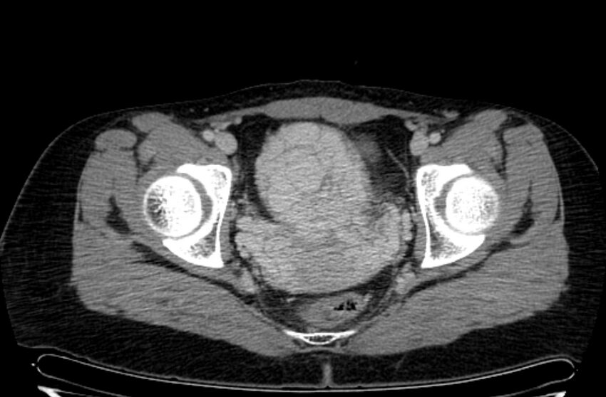 Cannonball metastases - uterine choriocarcinoma (Radiopaedia 70137-80174 A 40).jpg