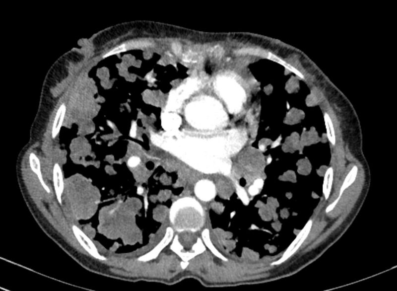 File:Cannonball metastases from breast cancer (Radiopaedia 91024-108569 A 66).jpg