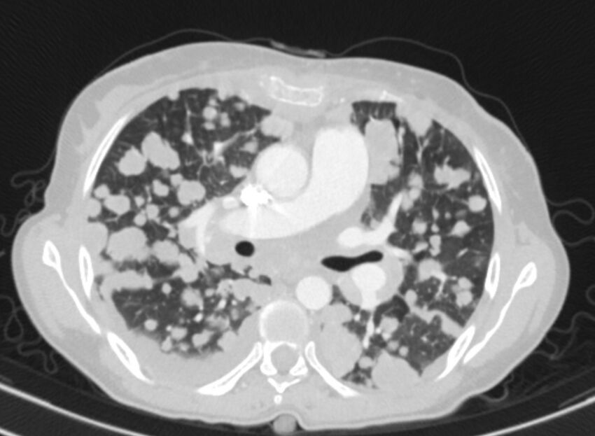 Cannonball metastases from breast cancer (Radiopaedia 91024-108569 Axial lung window 43).jpg