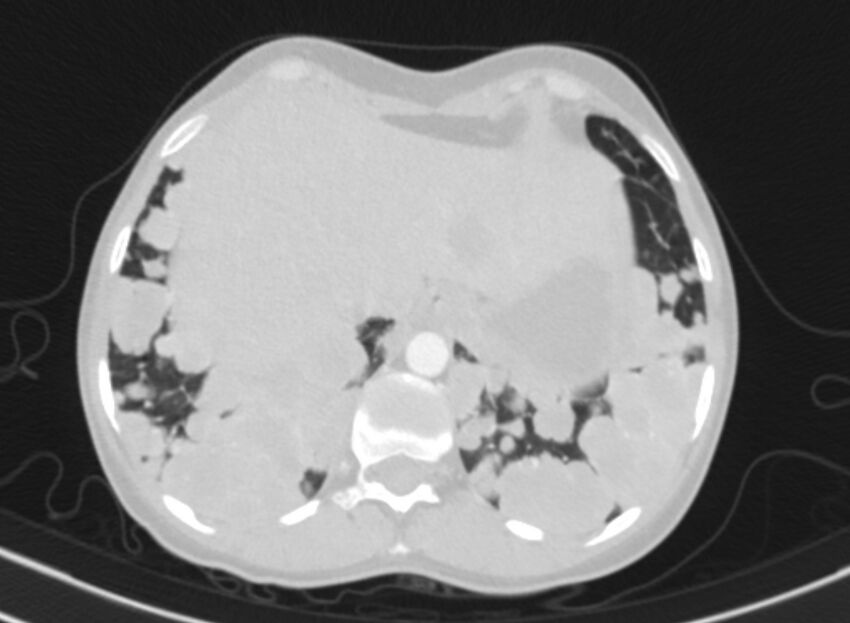 Cannonball metastases from breast cancer (Radiopaedia 91024-108569 Axial lung window 89).jpg