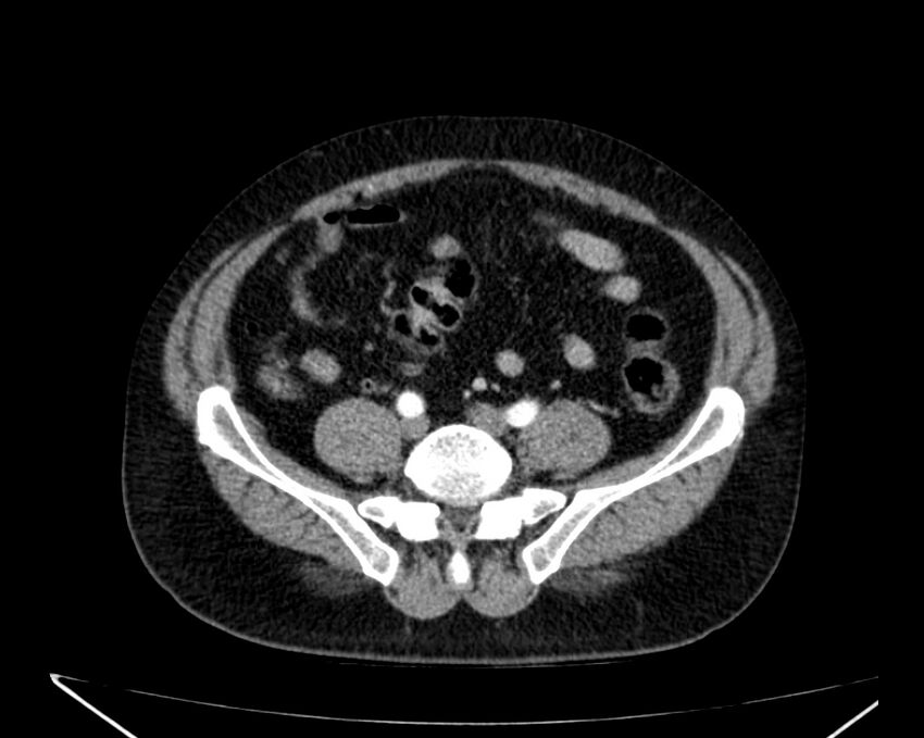 Carcinoid tumor with hepatic metastases (Radiopaedia 22651-22670 B 62).jpg