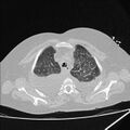 Cardiogenic pulmonary edema (Radiopaedia 29213-29609 Axial lung window 15).jpg