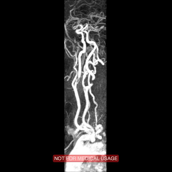 File:Carotid artery stenosis (Radiopaedia 28786-29087 3D MRA 14).jpg
