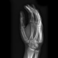 Carpometacarpal fracture dislocation (Radiopaedia 12674-12852 Oblique 1).jpg