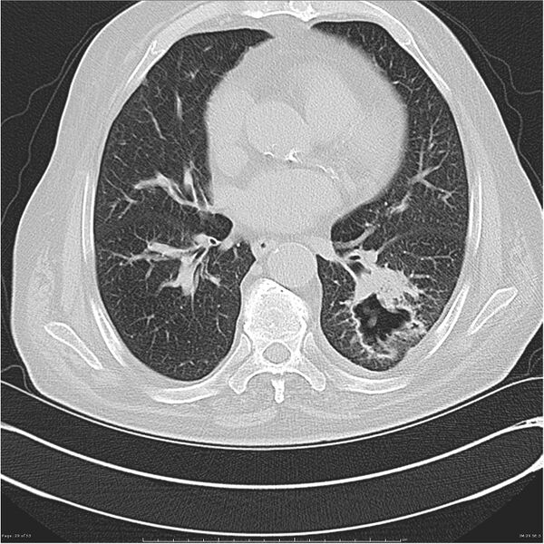 File:Cavitating left lower lobe lesion - squamous cell lung cancer (Radiopaedia 27749-28176 Axial lung window 29).jpg