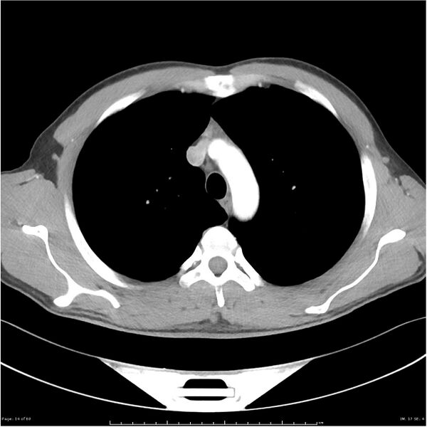 File:Cavitating lung cancer (Radiopaedia 25796-25945 C+ arterial phase 14).jpg