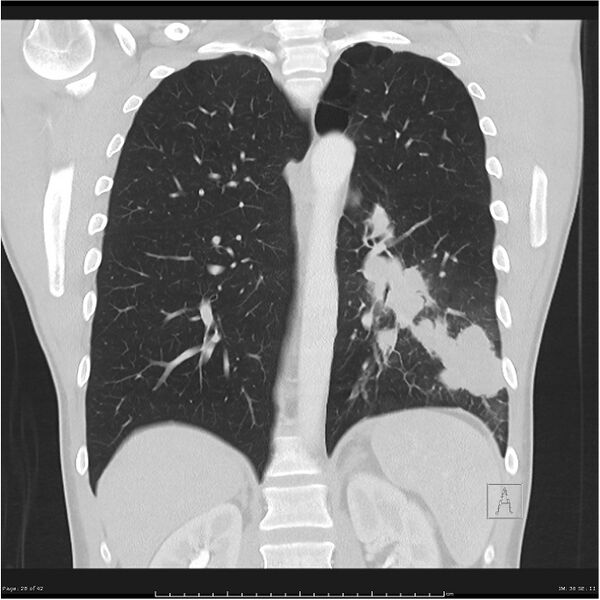 File:Cavitating lung cancer (Radiopaedia 25796-25945 lung window 28).jpg