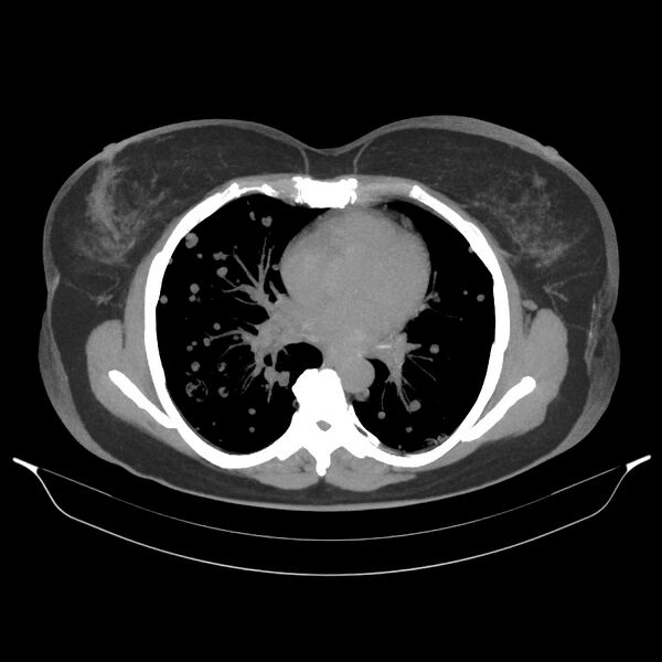 File:Cavitating pulmonary metastases (Radiopaedia 17796-17555 Axial non-contrast 1).jpg