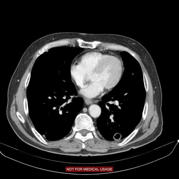 File:Cavitating pulmonary metastases (Radiopaedia 24920-25184 B 18).jpg