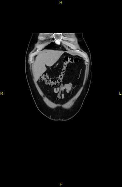 File:Cecal epiploic appendagitis (Radiopaedia 86047-102164 B 12).jpg
