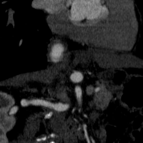File:Celiac artery aneurysm (Radiopaedia 21574-21525 B 10).JPEG