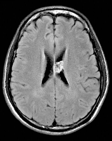 File:Central neurocytoma (Radiopaedia 2590-6285 Axial FLAIR 1).jpg