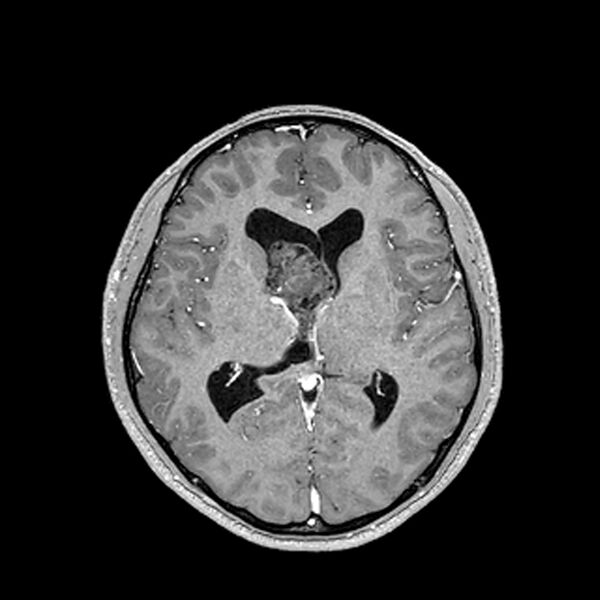 File:Central neurocytoma (Radiopaedia 79320-92380 Axial T1 C+ 131).jpg