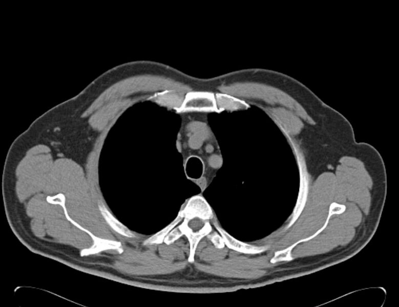 File:Centrilobular pulmonary emphysema (Radiopaedia 26808-26971 Axial non-contrast 8).jpg